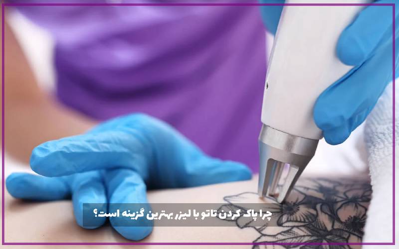 چرا پاک کردن تاتو با لیزر بهترین گزینه است؟