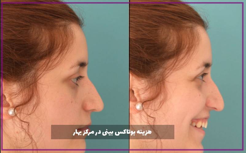 هزینه بوتاکس بینی در مرکز بهار