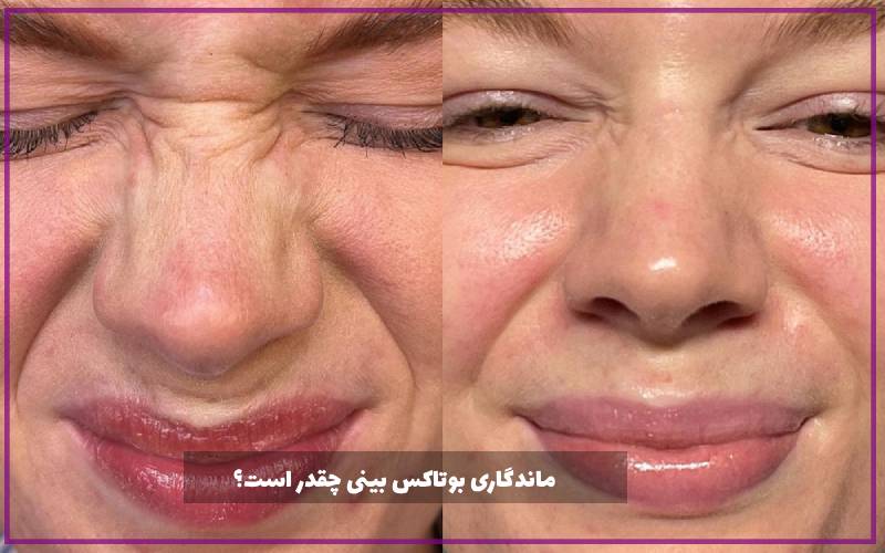 ماندگاری بوتاکس بینی چقدر است؟