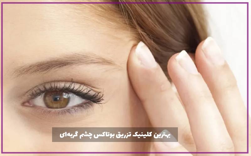 بهترین کلینیک تزریق بوتاکس چشم گربه‌ای