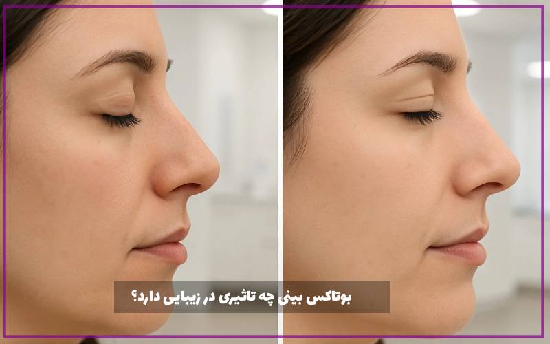 بوتاکس بینی چه تاثیری در زیبایی دارد؟