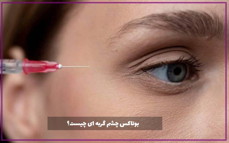 بوتاکس چشم گربه ای چیست؟