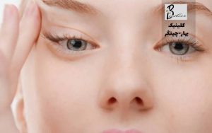 بوتاکس چشم گربه ای چیست؟